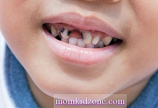 Kerosakan Gigi Pada Kanak Kanak Sebab Simptom Rawatan Kanak Besar 2021